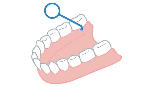 矯正用マウスピースが簡単に取れる!おすすめマウスピースリムーバーを紹介します